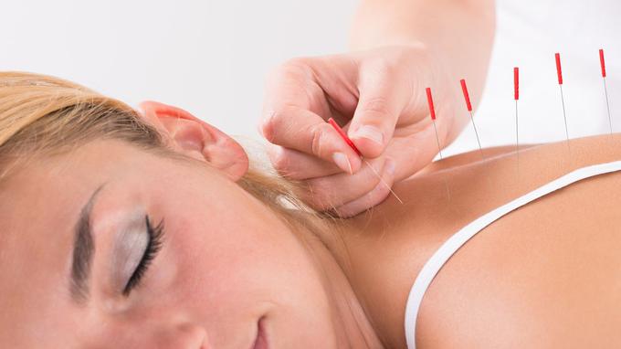 acupuncture