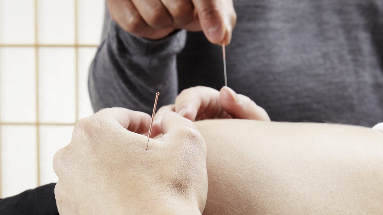 acupuncture