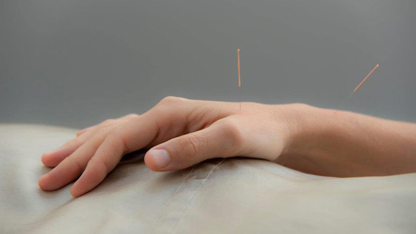 acupuncture
