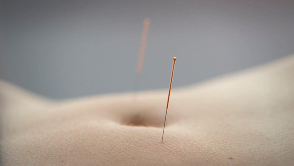 acupuncture